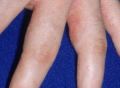 “汗疱疹”如何根治？它与湿疹的关系？与手足癣的区别？都解答在这里了！