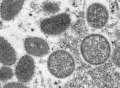 美现首例孕妇猴痘病例：新生儿被注射免疫球蛋白，已安全出生