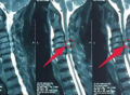 拍完颈椎核磁片子后，报告单上显示“脊髓水肿”是什么意思？