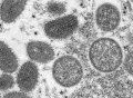 美国发现首例孕妇猴痘病例