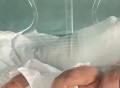 手掌大的宝宝你见过吗？利川人民医院刷新超早产儿救治记录！