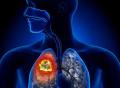 早期肺癌术后病理提示有气道播散，是不是意味着容易发生转移？