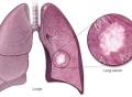 肺癌靶向新药贝福替尼，最新临床数据出炉