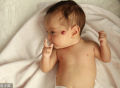 【重庆长峰医院】孕妈们要注意这些，谨防宝宝血管瘤！