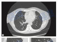 鳞状细胞肺癌未经治疗，完全自发消退，是怎么回事？
