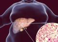阻止癌症发生，脂肪也可以立大功！华人科学家发现遏制肝癌新方法