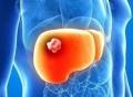 B超提示肝脏占位，都有哪些原因？