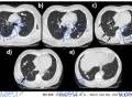 肺转移的肠癌患者，如何实现长期生存？