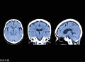 脑萎缩是痴呆的前兆吗？怎么分辨生理性和病理性？一文讲清