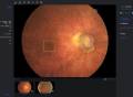 AI辅助有望解决青光眼诊断医疗资源不均难题