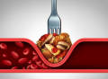 日本将“餐后甘油三酯”列入血脂异常标准！心内科专家解读这项指标的意义