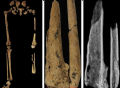 国际最新研究：3万年前人类已能做截肢手术