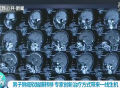 南京：男子肺癌软脑膜转移 医生用新技术“阻击”