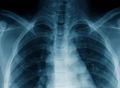 AI识别疾病媲美放射科医生，通过X光精准识别肺炎和肺功能衰竭