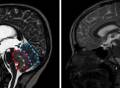 《自然》双重磅：破解儿童最常见脑瘤的起源之谜！